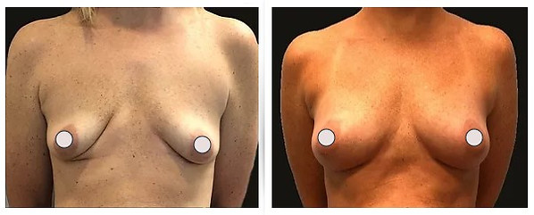 A result from Dr. Binh Nguyen, MD, Board Certified Plastic Surgeon