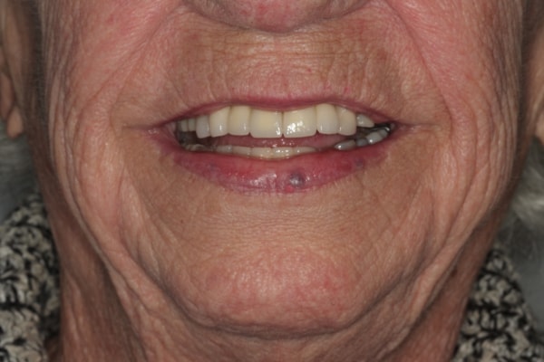A result from Harder Dental: Drs. Harder, Pham & Associates