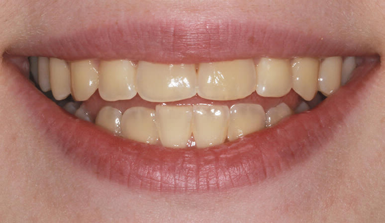 Teeth Whitening - Before & After