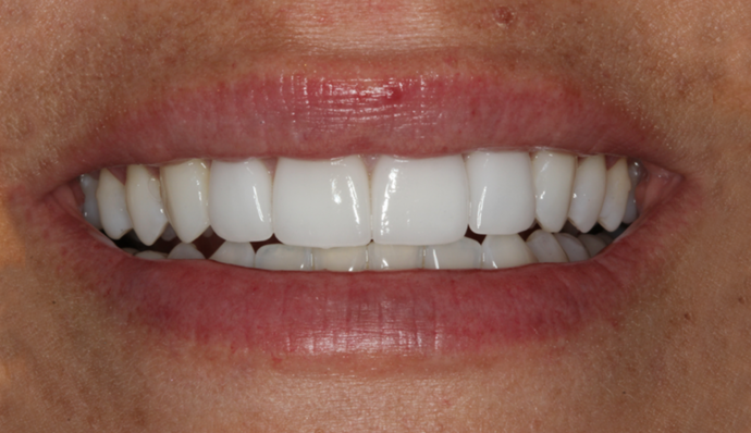Thomas Dental dental veneers result