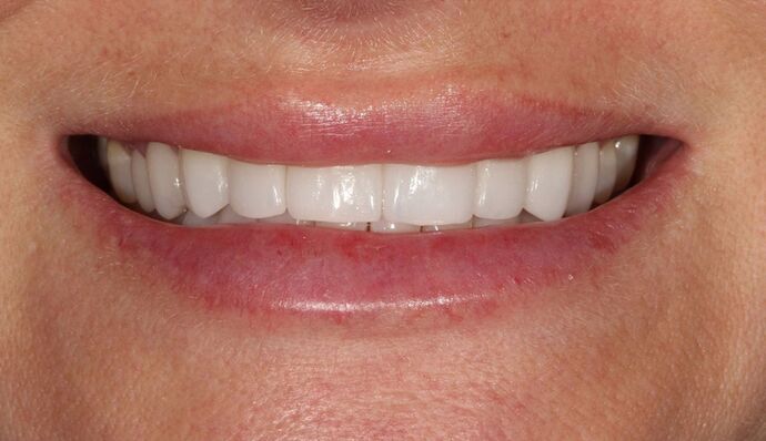 Thomas Dental smile makeover after — Salt Lake City, UT