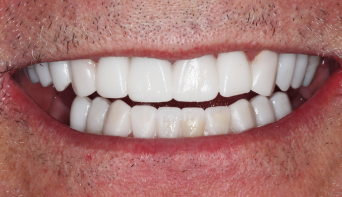 Thomas Dental smile makeover after — Salt Lake City, UT