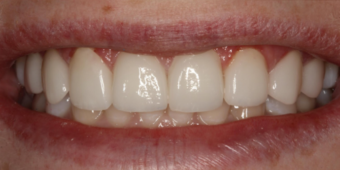 Thomas Dental smile makeover after — Salt Lake City, UT