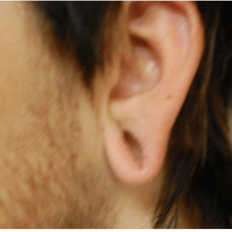 Otoplasty before photo