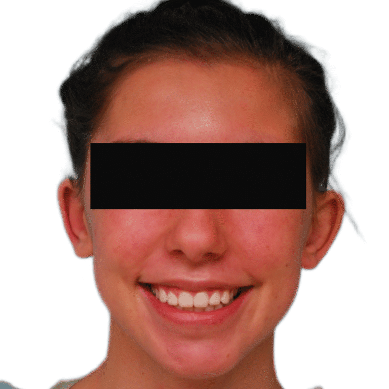 Otoplasty before photo