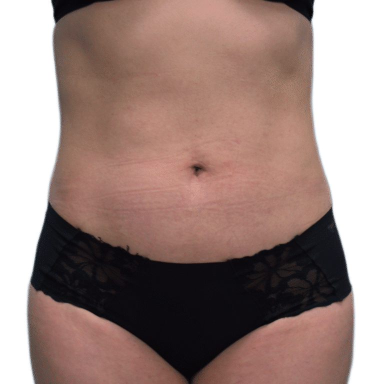 Envision Cosmetic Surgery liposuction after — Murray, UT
