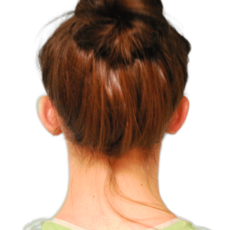 Otoplasty before photo