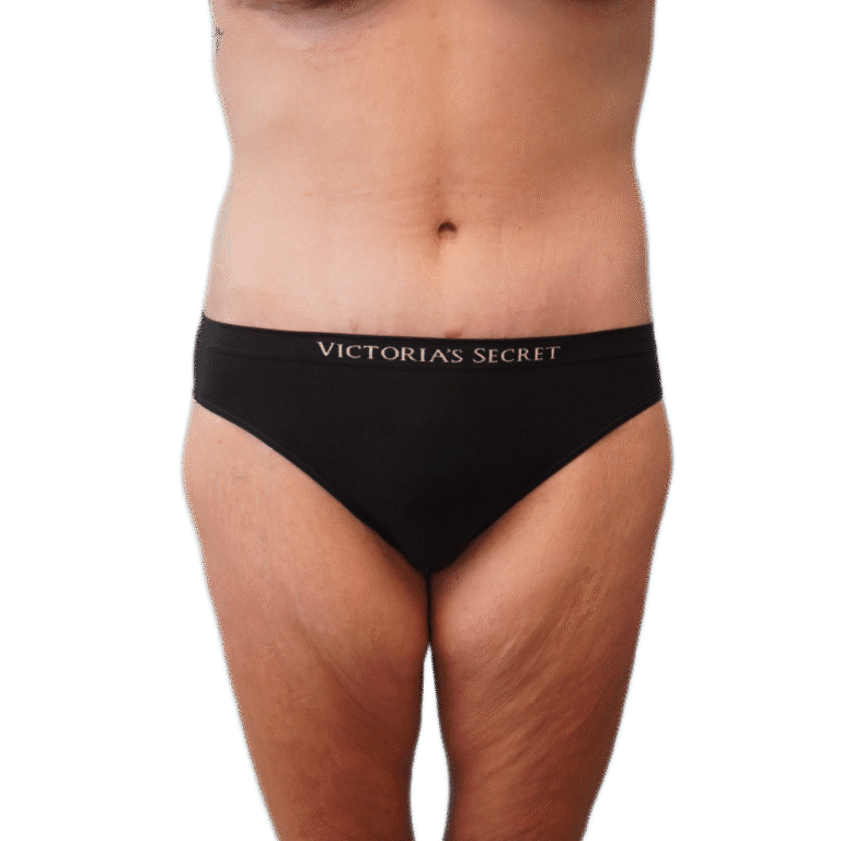 Envision Cosmetic Surgery liposuction after — Murray, UT