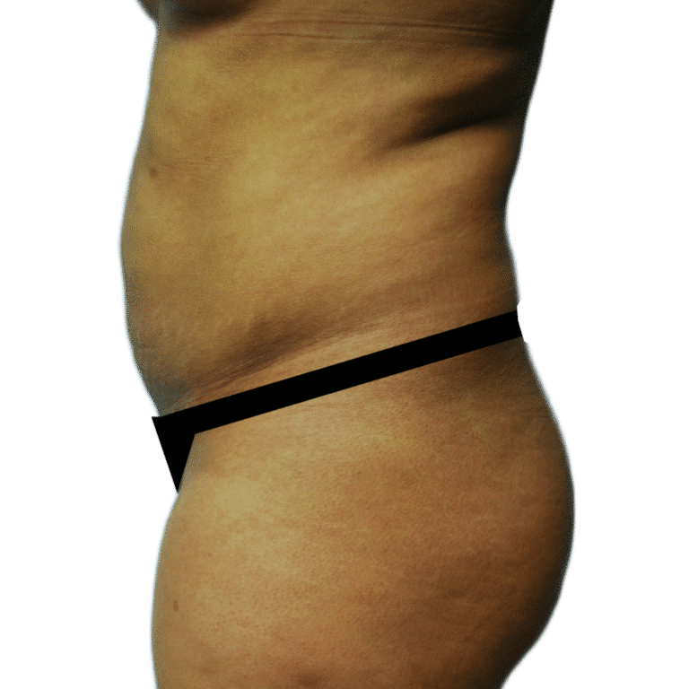 Tummy Tuck before photo