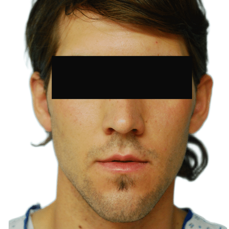 Otoplasty before photo