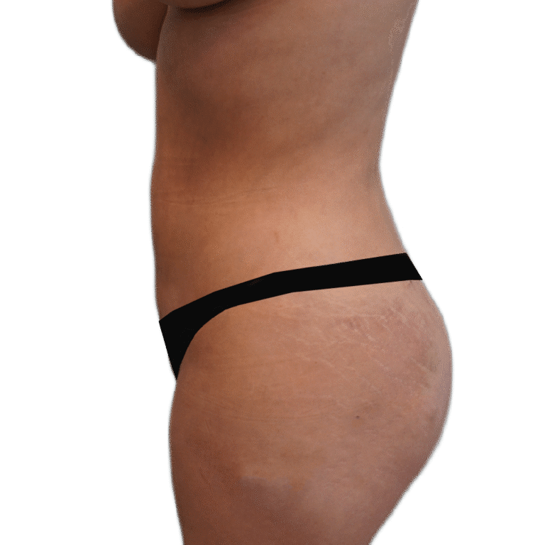 Envision Cosmetic Surgery liposuction after — Murray, UT