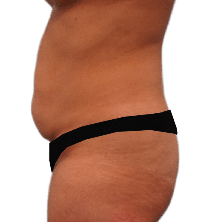 Tummy Tuck before photo