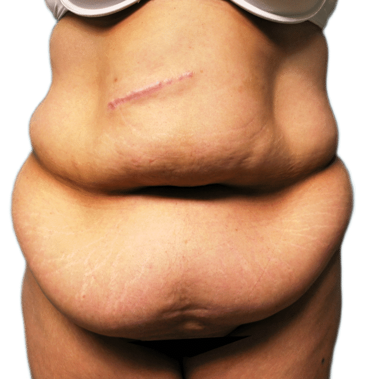 Tummy Tuck before photo