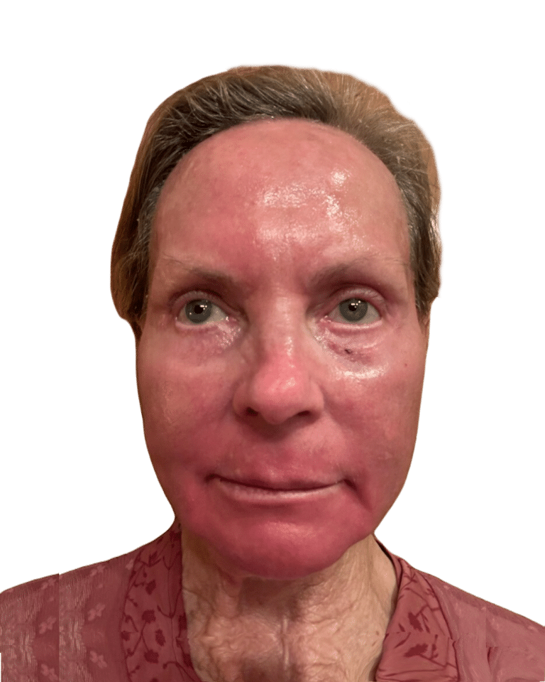 Chemical Peel before photo