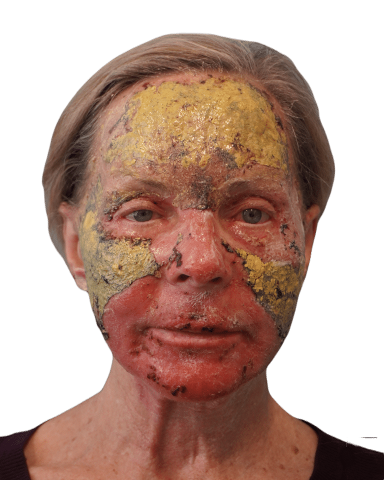 Chemical Peel before photo