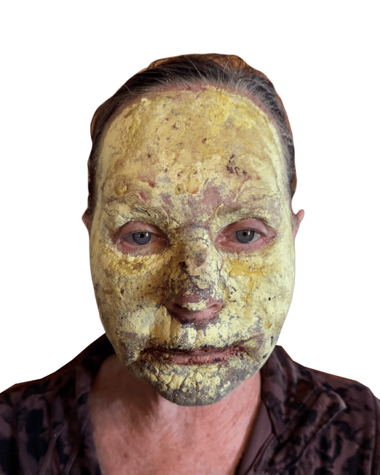 Chemical Peel before photo