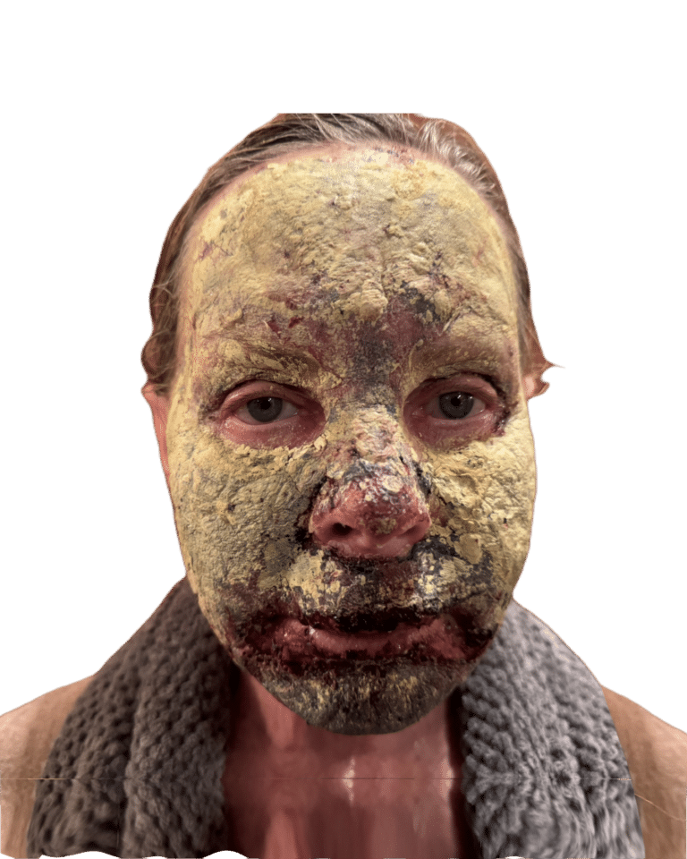 Chemical Peel before photo