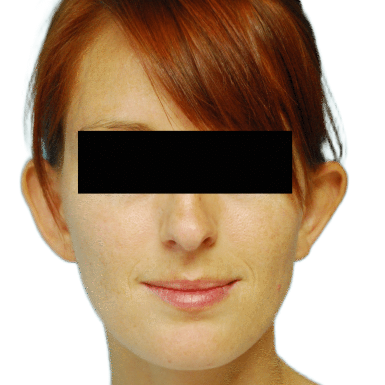 Otoplasty before photo