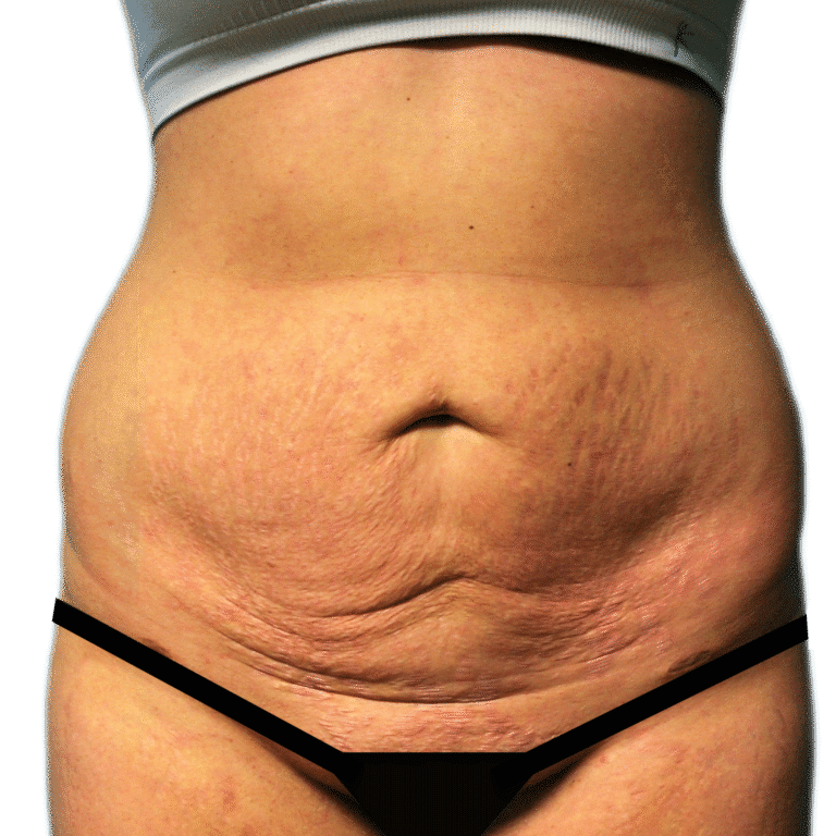 Tummy Tuck before photo