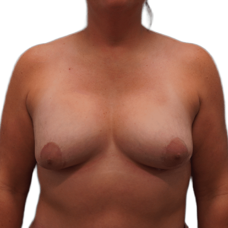 Breast Augmentation before photo