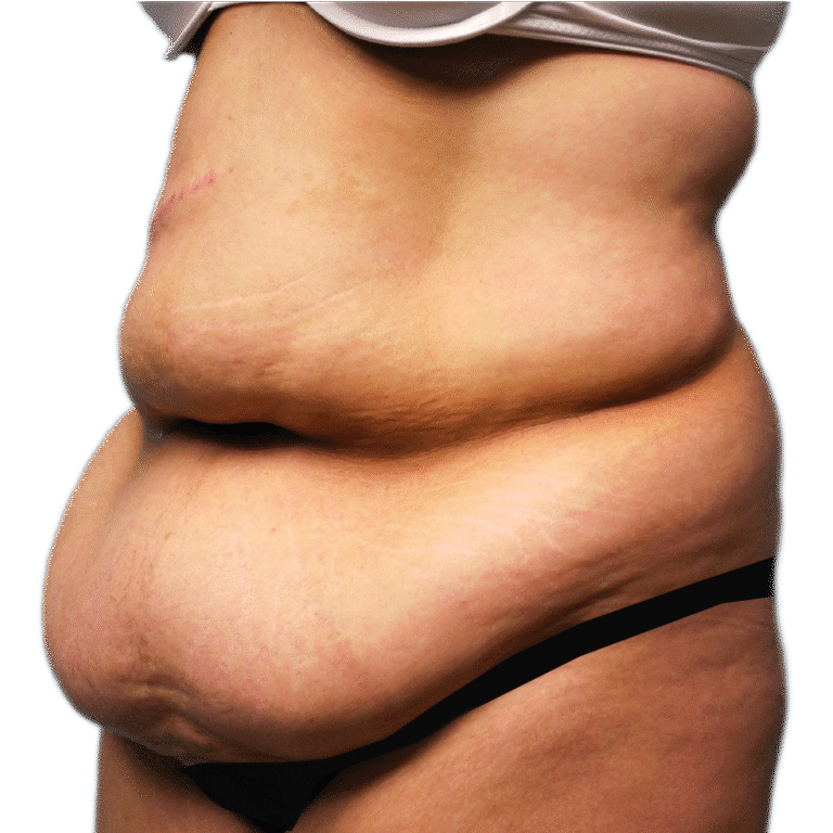 Tummy Tuck before photo