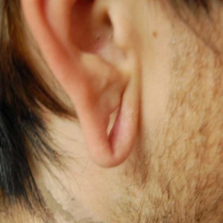 Otoplasty before photo