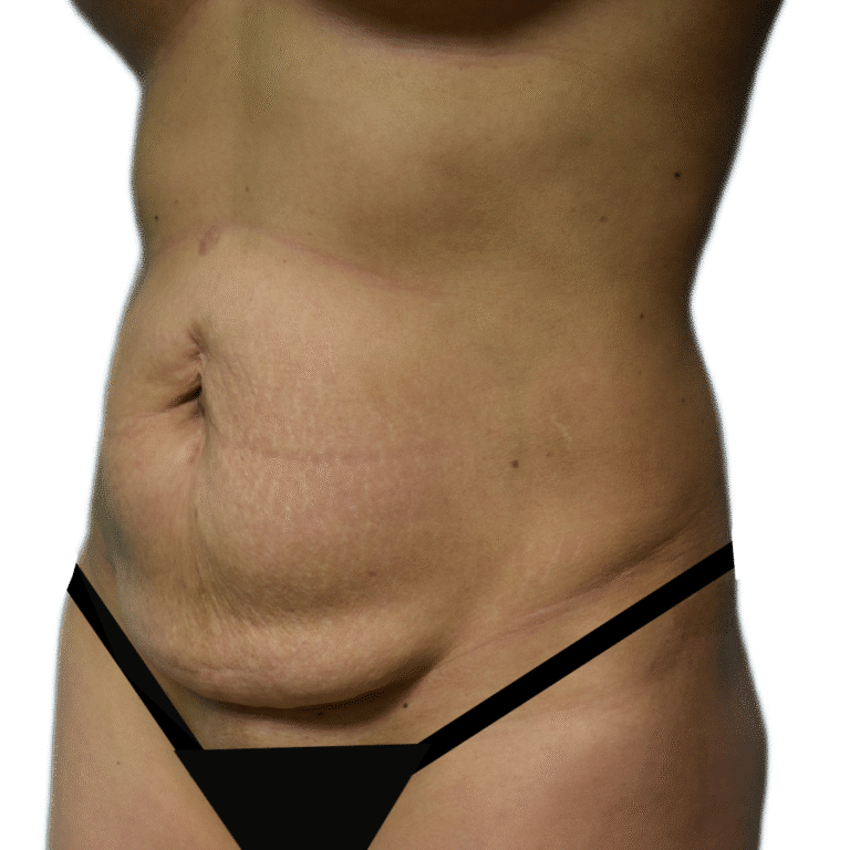 Tummy Tuck before photo
