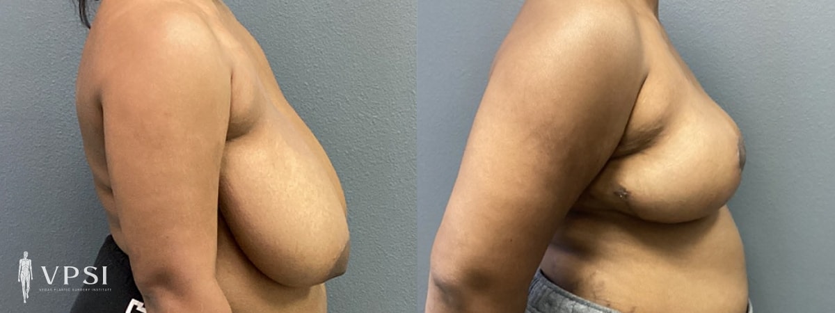 A result from Vegas Plastic Surgery Institute