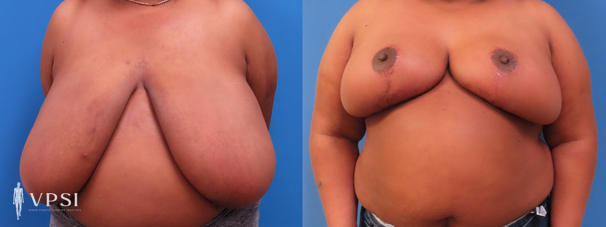 Vegas Plastic Surgery Institute breast reduction result — Las Vegas, NV