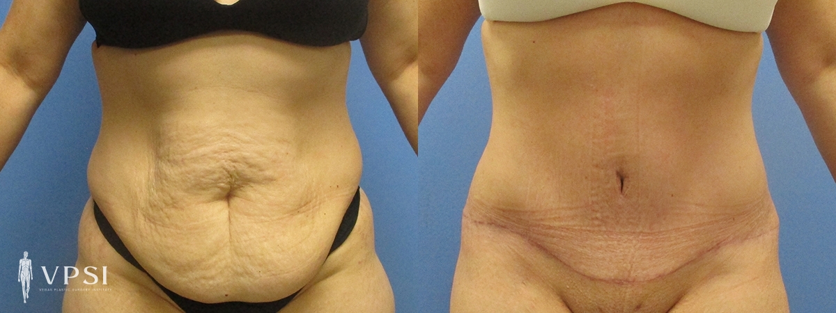 Vegas Plastic Surgery Institute tummy tuck result — Las Vegas, NV