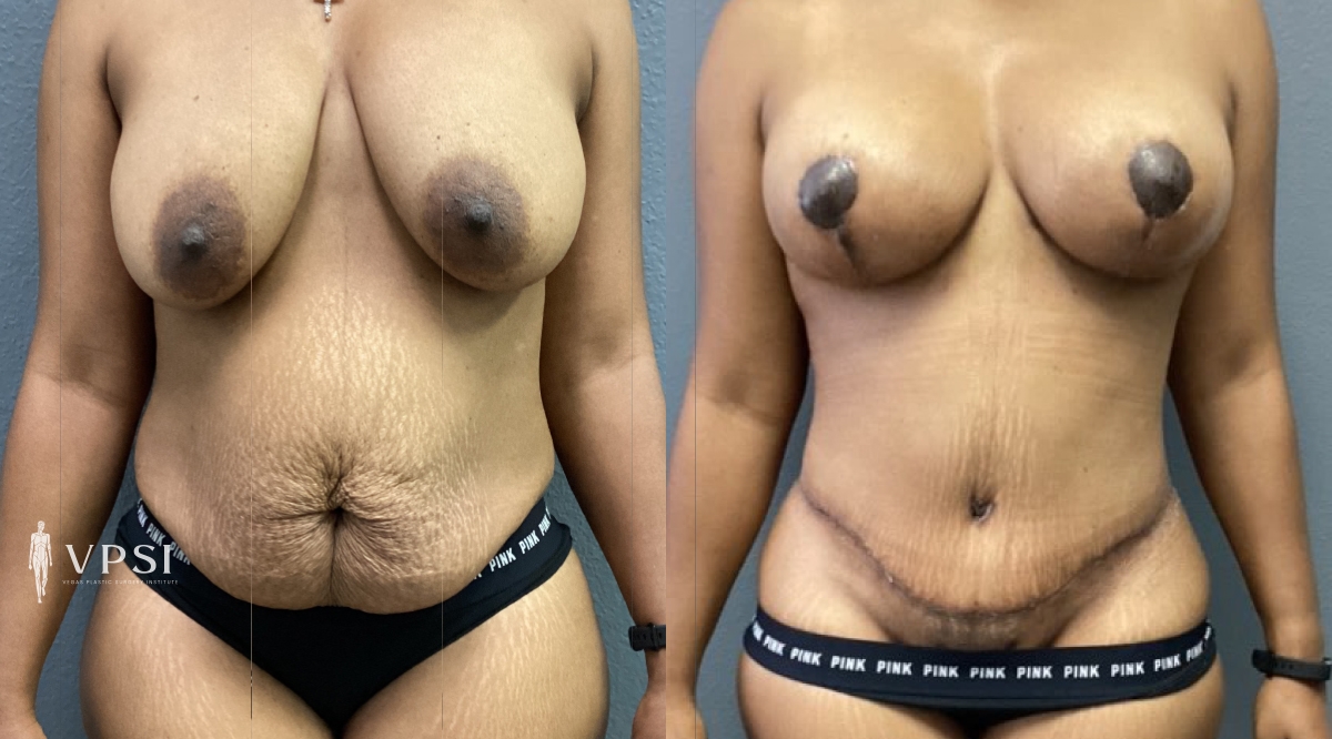 Vegas Plastic Surgery Institute mommy makeover result — Las Vegas, NV