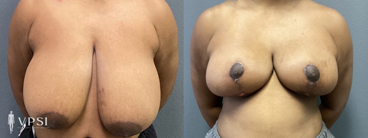 Vegas Plastic Surgery Institute breast reduction result — Las Vegas, NV