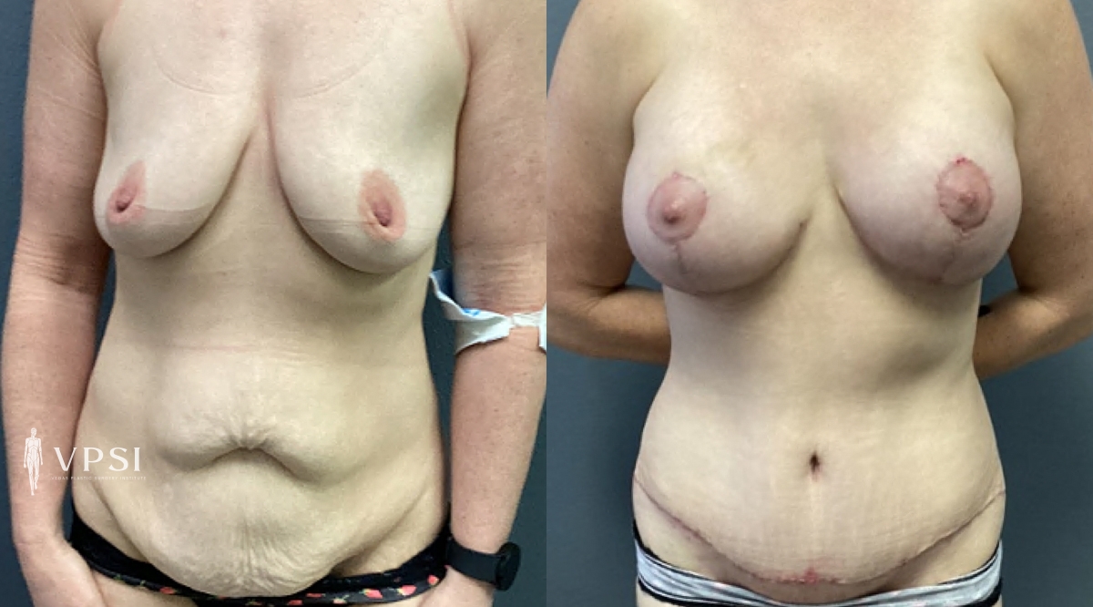 Vegas Plastic Surgery Institute mommy makeover result — Las Vegas, NV