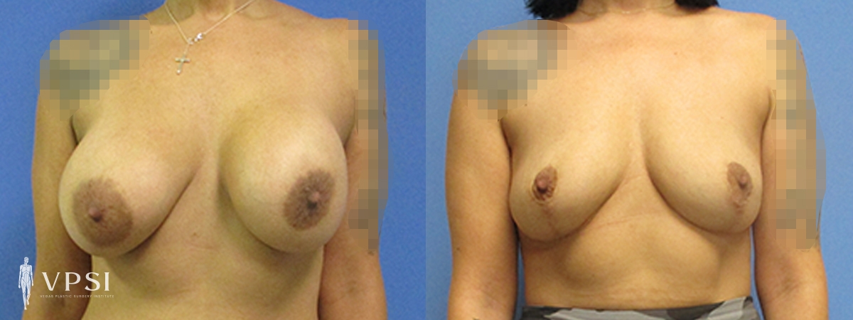 Breast Lift result at Vegas Plastic Surgery Institute