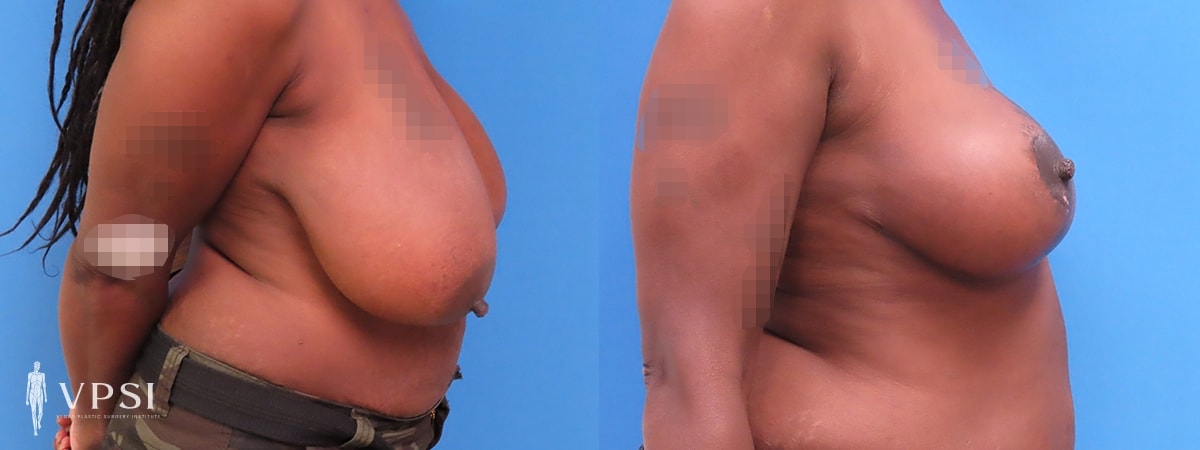 A result from Vegas Plastic Surgery Institute