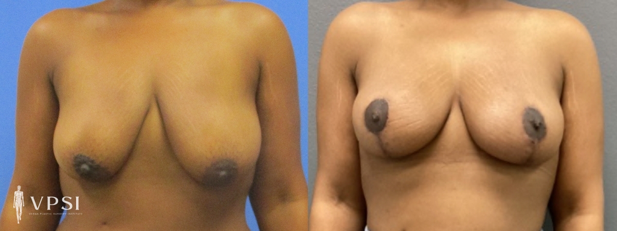 Breast Lift result at Vegas Plastic Surgery Institute