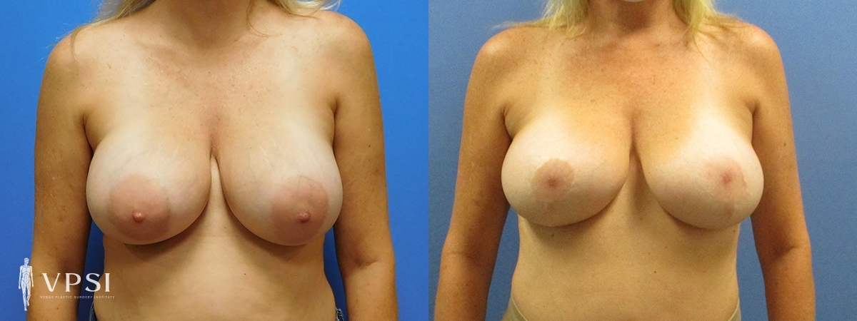 Breast Augmentation result at Vegas Plastic Surgery Institute