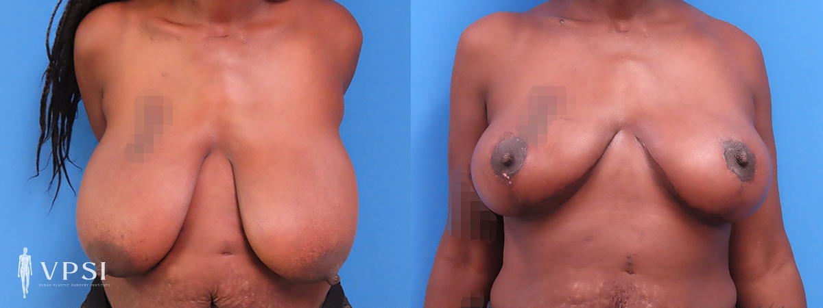 Vegas Plastic Surgery Institute breast reduction result — Las Vegas, NV