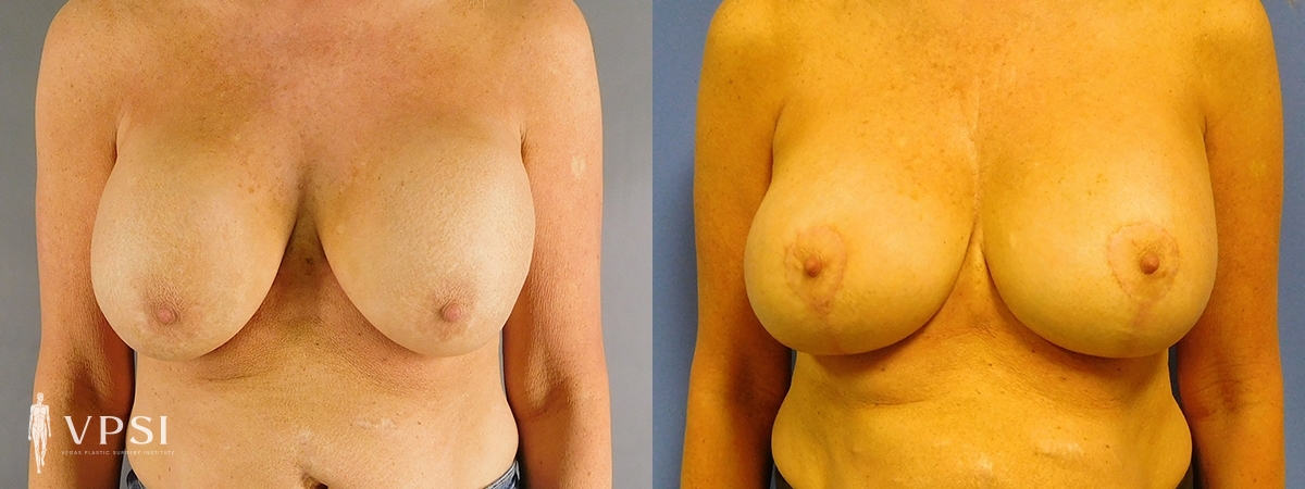 Breast Augmentation result at Vegas Plastic Surgery Institute