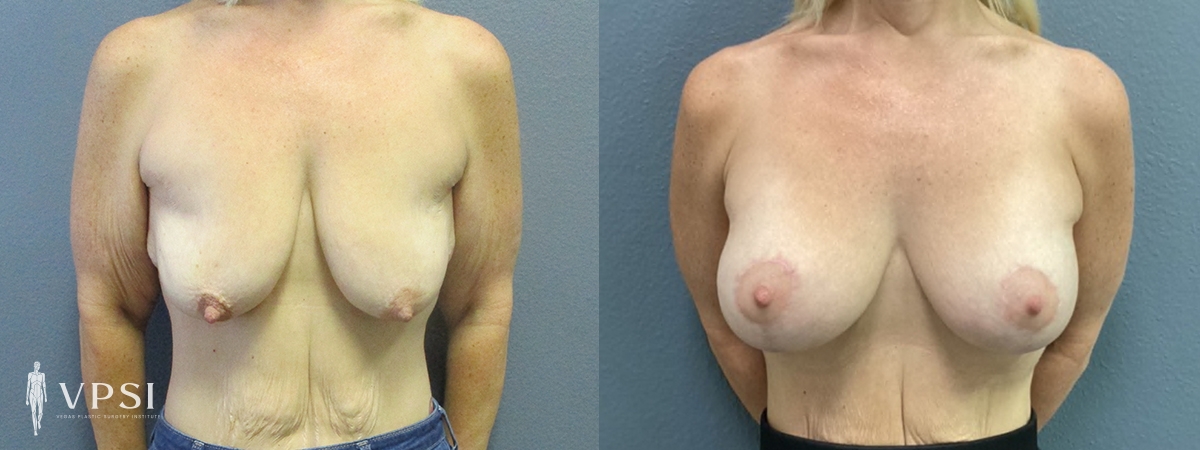 Breast Augmentation result at Vegas Plastic Surgery Institute
