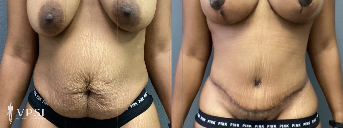 Vegas Plastic Surgery Institute tummy tuck result — Las Vegas, NV