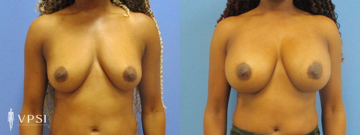 Breast Augmentation result at Vegas Plastic Surgery Institute
