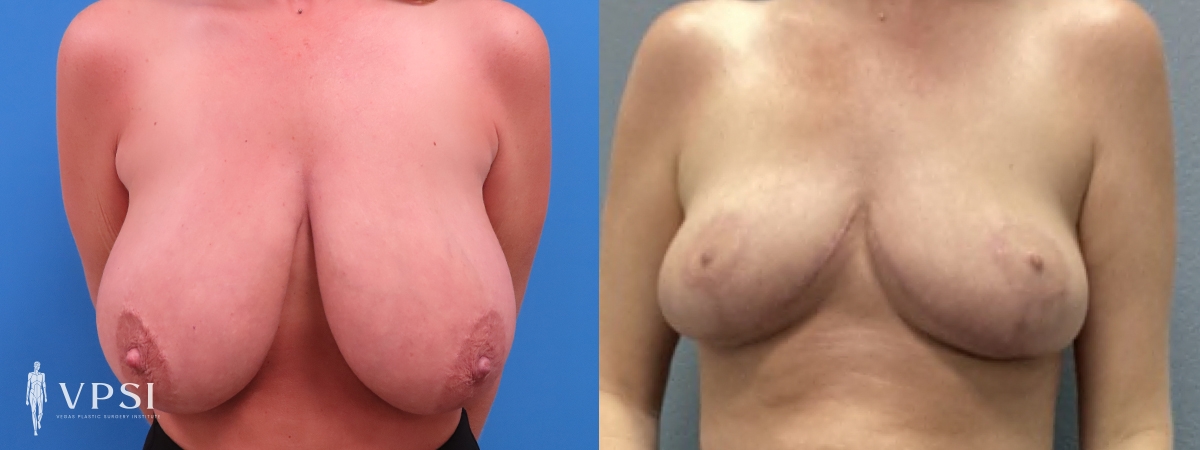 Vegas Plastic Surgery Institute breast reduction result — Las Vegas, NV