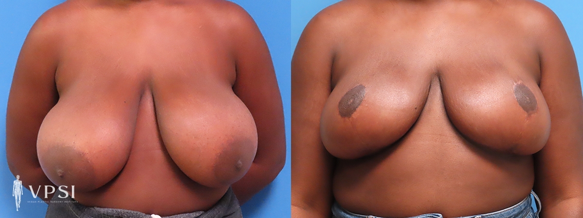 Vegas Plastic Surgery Institute breast reduction result — Las Vegas, NV