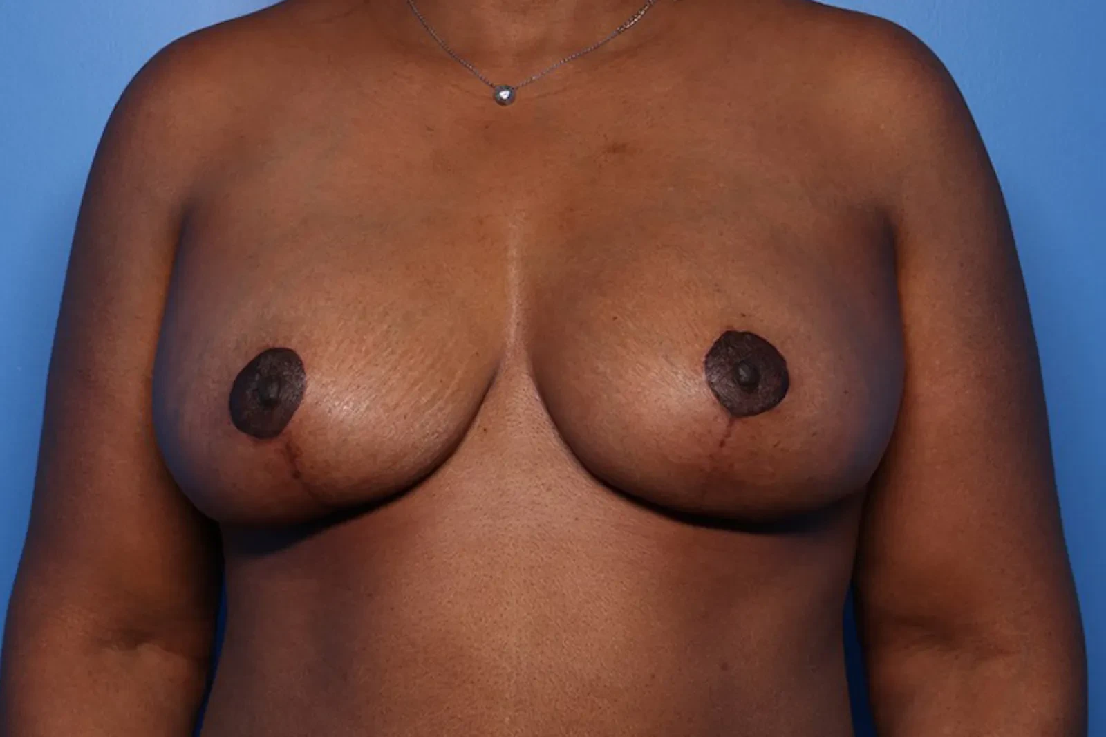 A result from Setty Plastic Surgery