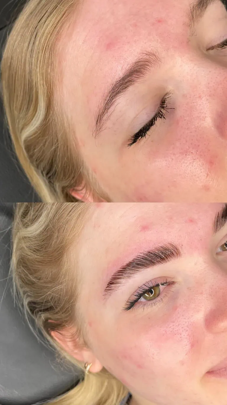 Hair Restoration result at Optimal Health Family Practice & Medspa