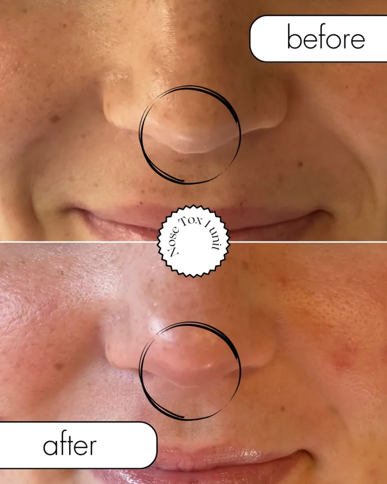 Rhinoplasty result at Optimal Health Family Practice & Medspa
