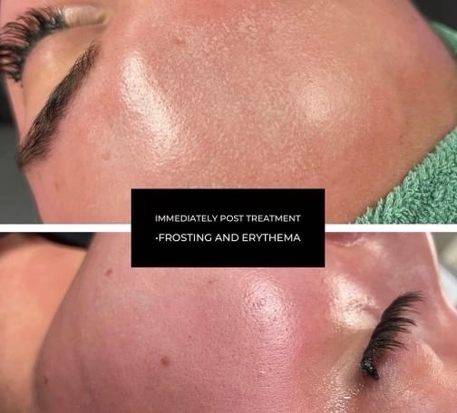 Rhinoplasty result at Optimal Health Family Practice & Medspa