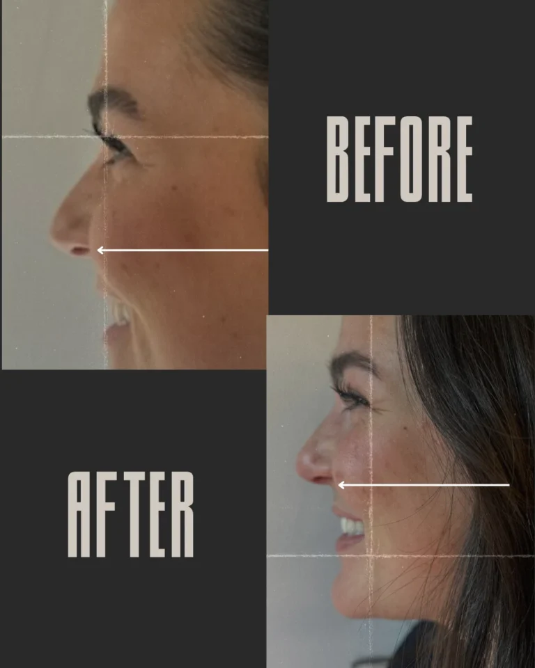 Rhinoplasty result at Optimal Health Family Practice & Medspa