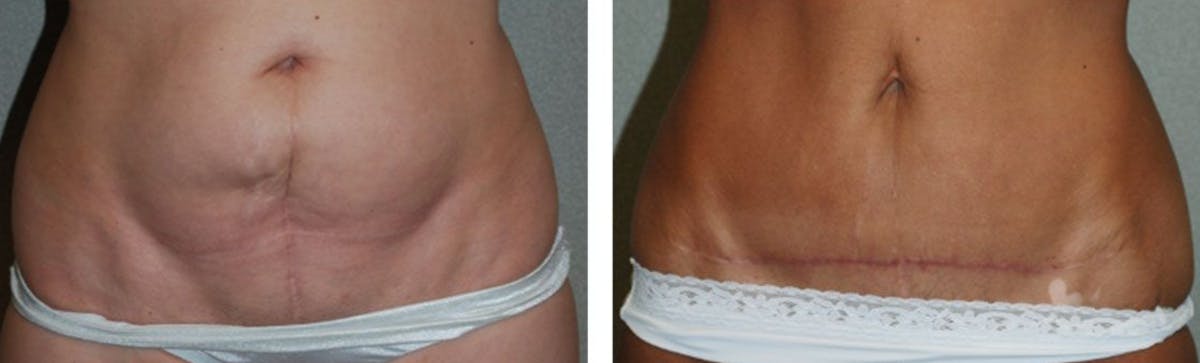 A result from Fort Lauderdale Plastic Surgery